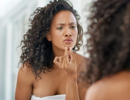 My Skin Breaks Out Every Time I Eat Dairy: Here’s Why (and What You Can Do About It)