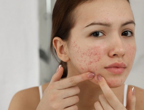 Why Your Gut Might Be the Reason Your Skin Won’t Clear: Here’s How to Fix It